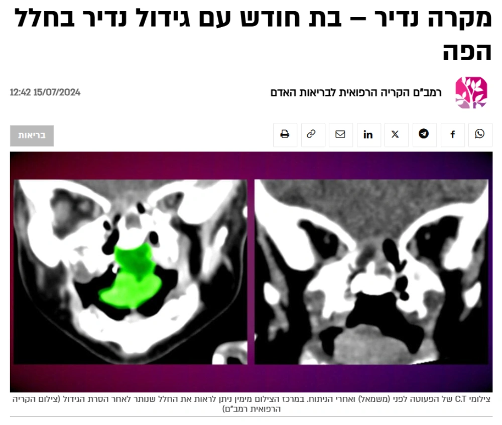 ד״ר טל קפושה השתתף בניתוח מורכב להסרת גידול נדיר בחלל הפה של תינוקת